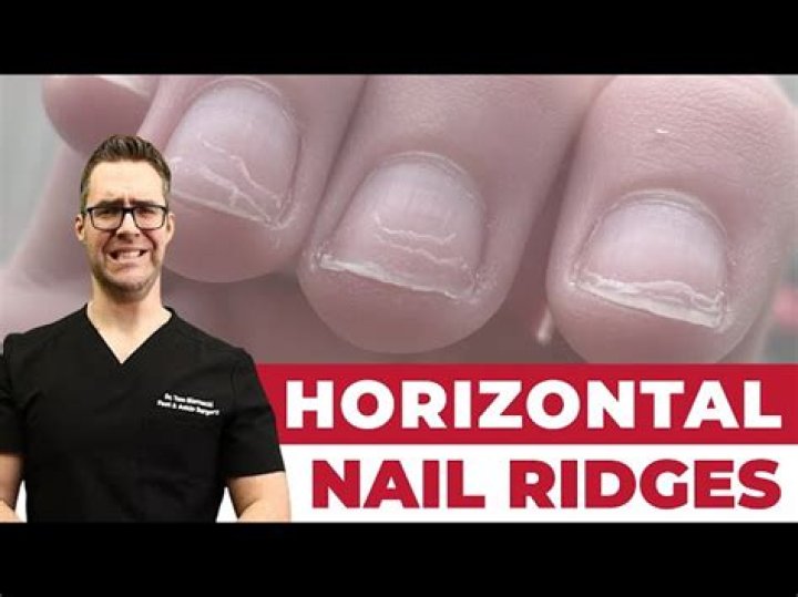 Understanding Horizontal Ridges On Fingernails: What Do They Indicate?